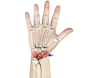 scaphoid artrosis