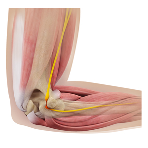 Cubital Tunnel Syndrome