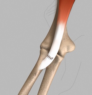 arthritis of thumb