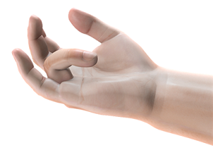 Dupuytren's Contracture