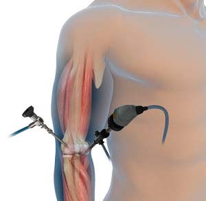 Elbow arthroscopy