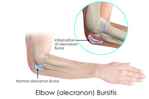 Olecranon Bursitis 