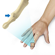 Finger Joint Fusion